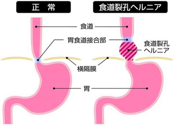 食道裂孔ヘルニア